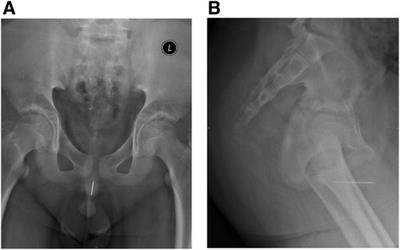 Laparoscopic extraction of a urethral self-inflicted needle from pelvis in a boy: a case report